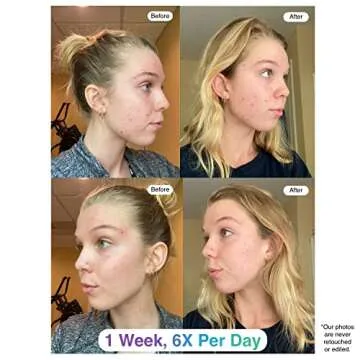 ClearSynergy One-Step Acne Treatment Foam for All Skin Types