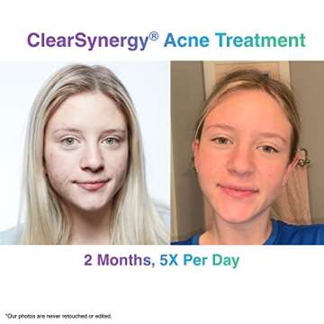ClearSynergy One-Step Acne Treatment Foam for All Skin Types