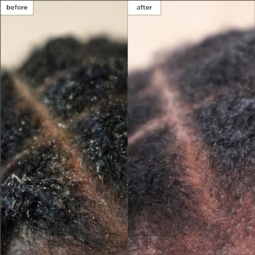 Effective Briogeo Scalp Treatment for Dry, Itchy Scalps