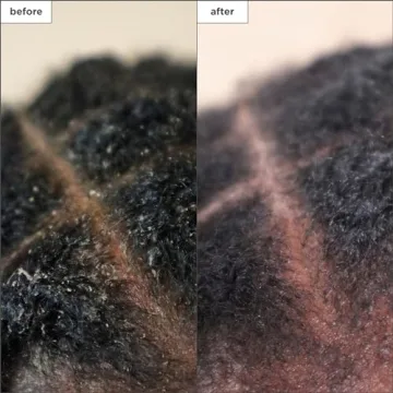 Effective Briogeo Scalp Treatment for Dry, Itchy Scalps
