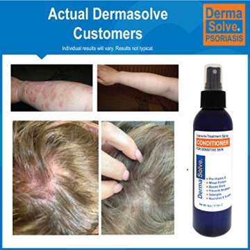 Dermasolve Psoriasis Leave-In-Treatment and Styling Spray Conditioner for Seborrheic Dermatitis, Sensitive Skin, Detangle, De-Flake, Soothing Anti Dandruff, Dry Scalp Repair for Damaged Hair
