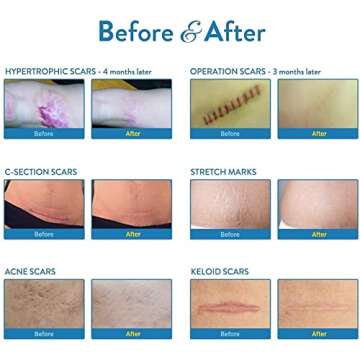 Aroamas Scar Silicone Scar Tape– Softens & Flattens Scars from Surgery, Injury, Burns, C-Section, Scratch Marks – Reusable Medical-Grade Silicone Scar Sheets for All Skin Types [3"x1.57", 8 Sheets]