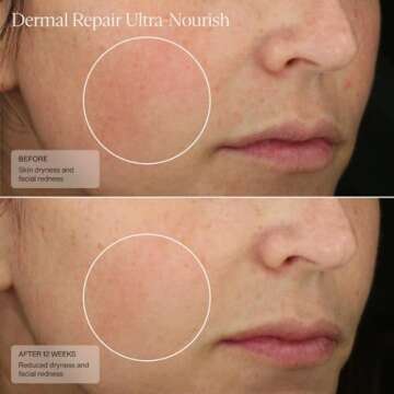 Sente Dermal Repair Cream - Nourishing Rosacea Solution