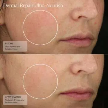 Sente Dermal Repair Cream - Nourishing Rosacea Solution