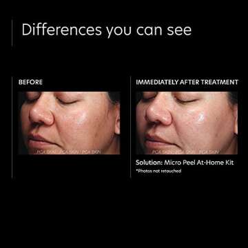 PCA SKIN Micro Peel Hyperpigmentation & Dark Spot Corrector Kit (Lactic Acid Facial Wash, Hydrating Toner, Blemish Remover Mask, Advanced Brightening Treatment, Anti Aging Serum, Face Cream, SPF 50+)
