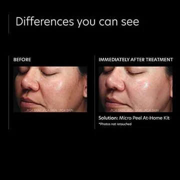 PCA SKIN Micro Peel Hyperpigmentation & Dark Spot Corrector Kit (Lactic Acid Facial Wash, Hydrating Toner, Blemish Remover Mask, Advanced Brightening Treatment, Anti Aging Serum, Face Cream, SPF 50+)