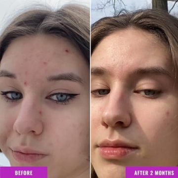 Good Molecules Niacinamide Serum for Acne, Tone, Texture