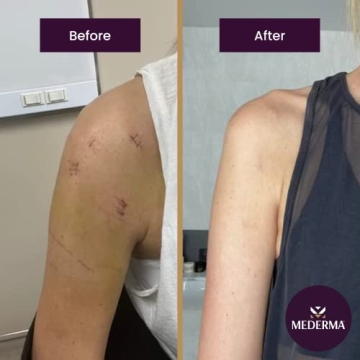 Mederma Advanced Scar Gel - #1 Doctor Recommended Scar Solution