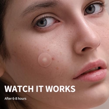 Daolyo Pimple Patches - Clear Skin Naturally, 300 Counts