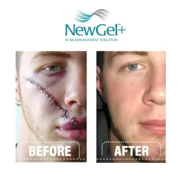 NewGel Plus Scar Gel: Advanced Treatment for All Scars