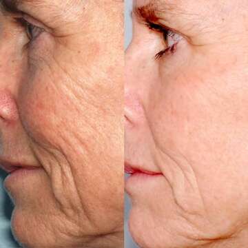 PMD Beauty Microderm Classic | Home Microdermabrasion Kit for Face | Exfoliating Crystals and Suction Help Circulation to Boost Collagen for Radiant Skin