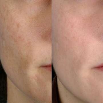 PMD Beauty Microderm Classic | Home Microdermabrasion Kit for Face | Exfoliating Crystals and Suction Help Circulation to Boost Collagen for Radiant Skin