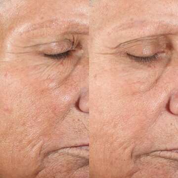 PMD Microderm Classic | Home Microdermabrasion Kit for Face | Exfoliating Crystals and Suction Help Circulation to Boost Collagen for Radiant Skin