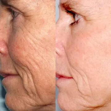 PMD Microderm Classic | Home Microdermabrasion Kit for Face | Exfoliating Crystals and Suction Help Circulation to Boost Collagen for Radiant Skin