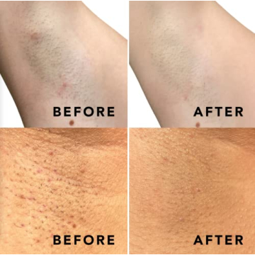 Daily Treatment Pads for Ingrown Hairs & Razor Bumps