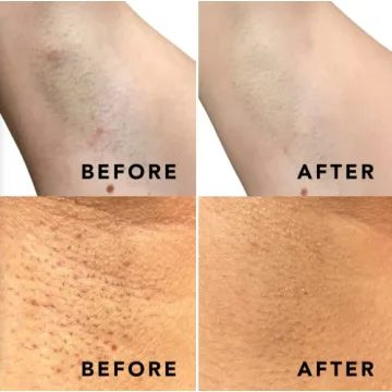 Daily Treatment Pads for Ingrown Hairs & Razor Bumps