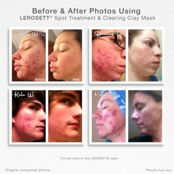 Vegan Acne Clay Mask for Oily Skin - LEROSETT