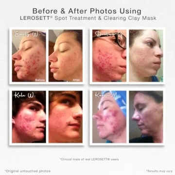 Vegan Acne Clay Mask for Oily Skin - LEROSETT