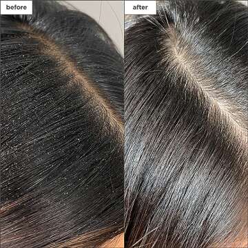 Briogeo Scalp Revival Charcoal + Tea Tree Buildup Detox Spray, Dry Scalp Pre-Wash Treatment for Dry ...