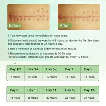 Silicone Scar Sheets(1.8” x 157”Inch- 4M), Scar Tape, Scar Strips, Medical Grade, Scar Remover, C-Section, Surgery, Keloid, Tummy Tuck, Scar Patch.