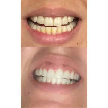 Smile Titan Teeth Whitening Kit with LED Light, 3 Carbamide Peroxide Teeth Whitening Gel Express Teeth Whitener. Remove Stains from Coffee, Smoking, Wine, Food (5 Piece Set)