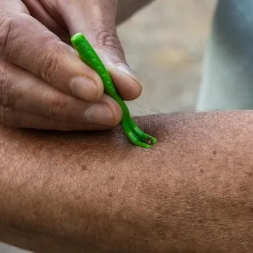 TickCheck Tick Remover Kit for Pets and Humans 3 Pack