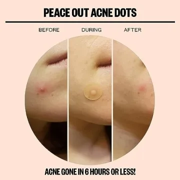 Peace Out Acne Dots for Clear Skin Overnight Solution