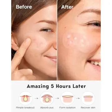 LitBear Large Acne Pimple Patches, 5 Sizes 80 Patches for Large Breakouts, Acne Patches for Face, Chin or Body, Acne Spot Patch with Tea Tree & Calendula Oil, Hydrocolloid Bandages for Acne Skin