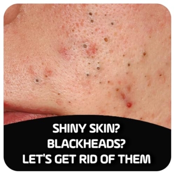 ASEPXIA Charcoal Soap for Oily Skin and Acne Control