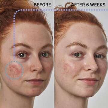 The INKEY List Azelaic Acid 10% Serum - Anti-Redness Skin Solution, 1.01 oz