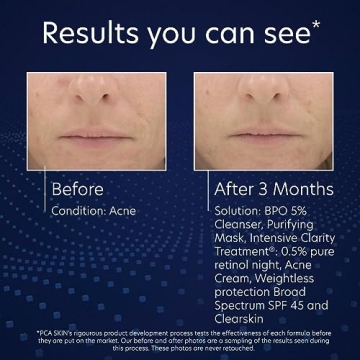 PCA SKIN Benzoyl Peroxide Face Wash for Acne-Prone Skin