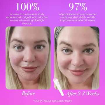 reVive Light Therapy Wand for Acne & Anti-Aging