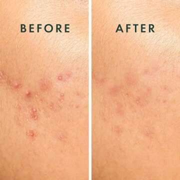 Rael Pimple Patches for Acne Control and Treatment