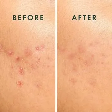 Rael Pimple Patches for Acne Control and Treatment