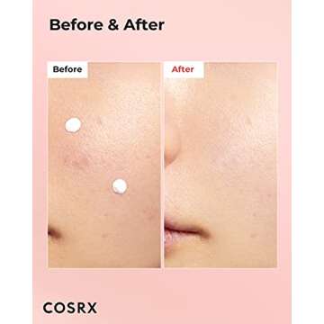 COSRX Acne Blemish Spot Drying Lotion 1.01 fl. oz / 30ml Dry and Reduce Blemish Spot, Pimple, Whiteh...