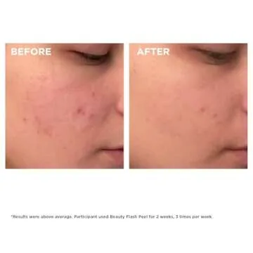 Clarins Beauty Flash Peel | Renew Your Radiance in 10 Minutes