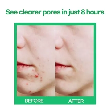 Fun Acne Patch Shapes Edition | Hydrocolloid Patches for Girls