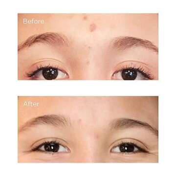 Perricone MD Acne Relief Prebiotic Acne Therapy