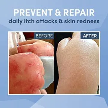 Wrap-E-Soothe Eczema Treatment Suit for Toddlers