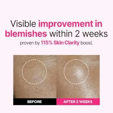 ISOI Blemish Care Up Serum, Vegan Hydrating Serum for Smooth & Glass Skin Effect, Skin Barrier & Moi...