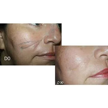Sodermix Cream for Scars - Psoriasis, Eczema & More - 30g
