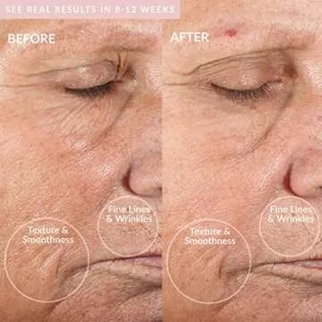 PMD Personal Microderm Classic for At-Home Use, Facial Exfoliator Tool, Microdermabrasion Machine Kit for Face and Body Skincare, With Recovery Mask, Blush