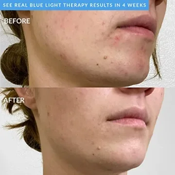 PMD Clean Acne Device with Blue Light Therapy & SonicGlow