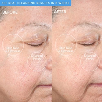 PMD Clean Acne Device with Blue Light Therapy & SonicGlow