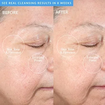 PMD Clean Acne Device with Blue Light Therapy & SonicGlow