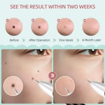 AL-40 Skin Removal Kit, Design to Smooth Your Skin, Safe and Effective for Home Use, Easy to Use Skin Tag Remover Kit