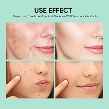 Anti Acne Face Mask - Salicylic Acid Skin Care Solution