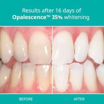 Opalescence 35% CP Mint Teeth Whitening Gel Syringes