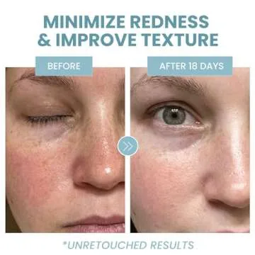 Azelaic Acid 10% Facial Serum, 2 oz., Skin Brightening Hyaluronic Acid and Niacinamide, Redness Relief, Fade and Repair Dark Spots