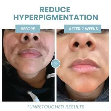 Azelaic Acid 10% Facial Serum, 2 oz., Skin Brightening Hyaluronic Acid and Niacinamide, Redness Relief, Fade and Repair Dark Spots